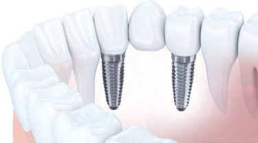 インプラントと差し歯の違い