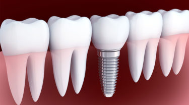 インプラント治療のトラブルを防ぐ