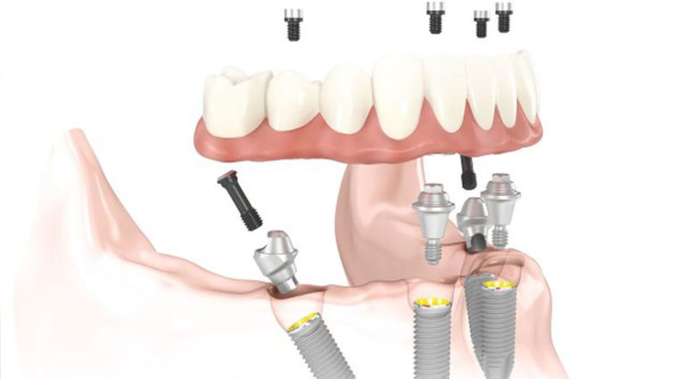 インプラントALL-ON-4