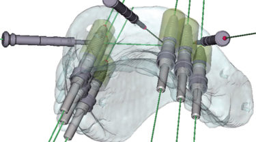 インプラントのコンピューターガイド