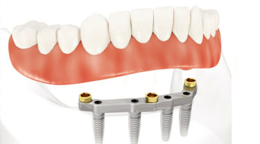 インプラント入れ歯/オーバーデンチャー