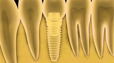 インプラントと骨結合のメカニズムとは