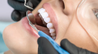 歯のクリーニングの重要性