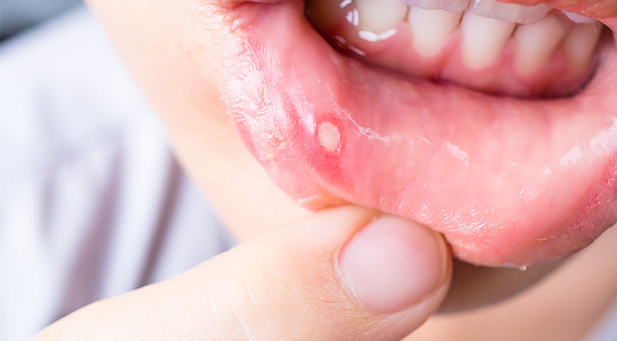 口内炎の原因と症状